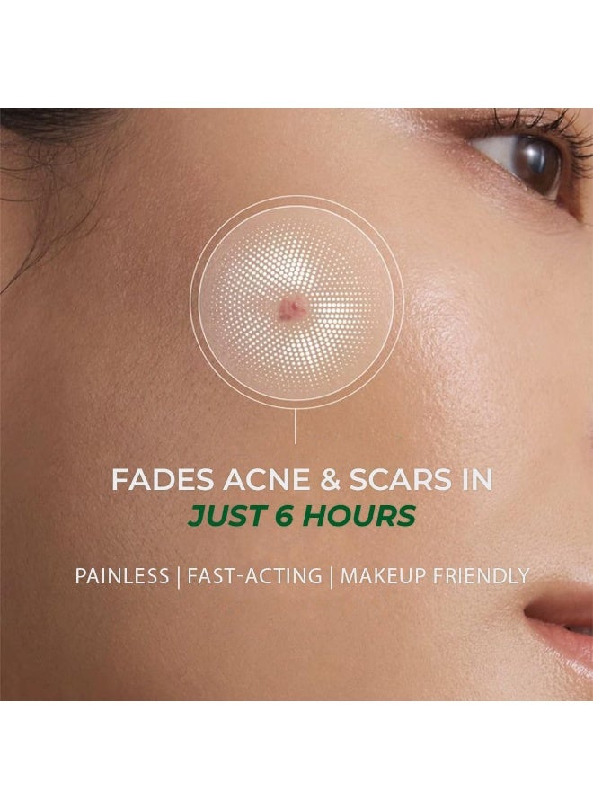 Conscious Chemist® Self Dissolving Microneedle Acne Patches (Pack of 8 Patches) | Painless & Effective Pimple Patches with 2% Salicylic Acid, Azelaic Acid & Niacinamide | Kills Bacteria, Reduces Redness, Scarring & Excess Sebum | Visible Results in 6 Hours - Image 2
